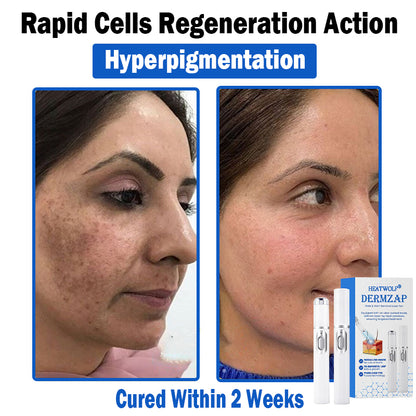 𝐇𝐄𝐀𝐓𝐖𝐎𝐋𝐅®👩‍⚕️ 𝐃𝒆𝐫𝐦𝒁𝐚𝐩 𝑵𝐁-𝐔𝐕𝐁 𝑴𝐨𝐥𝐞 & 𝑾𝐚𝐫𝐭 𝑹𝒆𝐦𝐨𝐯𝐚𝐥 𝑷𝐡𝐨𝐭𝐨𝐭𝐡𝐞𝐫𝐚𝐩𝐲 𝑳𝐚𝐬𝒆𝐫 𝑷𝐞𝐧 (Effectively inhibits excessive cell proliferation, eliminates inflammation and repairs the skin barrier)