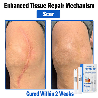𝐇𝐄𝐀𝐓𝐖𝐎𝐋𝐅®👩‍⚕️ 𝐃𝒆𝐫𝐦𝒁𝐚𝐩 𝑵𝐁-𝐔𝐕𝐁 𝑴𝐨𝐥𝐞 & 𝑾𝐚𝐫𝐭 𝑹𝒆𝐦𝐨𝐯𝐚𝐥 𝑷𝐡𝐨𝐭𝐨𝐭𝐡𝐞𝐫𝐚𝐩𝐲 𝑳𝐚𝐬𝒆𝐫 𝑷𝐞𝐧 (Effectively inhibits excessive cell proliferation, eliminates inflammation and repairs the skin barrier)