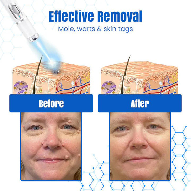 𝐇𝐄𝐀𝐓𝐖𝐎𝐋𝐅®👩‍⚕️ 𝐃𝒆𝐫𝐦𝒁𝐚𝐩 𝑵𝐁-𝐔𝐕𝐁 𝑴𝐨𝐥𝐞 & 𝑾𝐚𝐫𝐭 𝑹𝒆𝐦𝐨𝐯𝐚𝐥 𝑷𝐡𝐨𝐭𝐨𝐭𝐡𝐞𝐫𝐚𝐩𝐲 𝑳𝐚𝐬𝒆𝐫 𝑷𝐞𝐧 (Effectively inhibits excessive cell proliferation, eliminates inflammation and repairs the skin barrier)