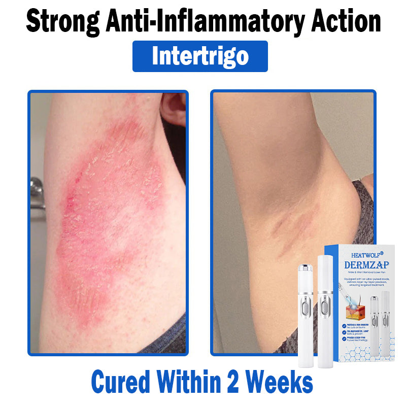 𝐇𝐄𝐀𝐓𝐖𝐎𝐋𝐅®👩‍⚕️ 𝐃𝒆𝐫𝐦𝒁𝐚𝐩 𝑵𝐁-𝐔𝐕𝐁 𝑴𝐨𝐥𝐞 & 𝑾𝐚𝐫𝐭 𝑹𝒆𝐦𝐨𝐯𝐚𝐥 𝑷𝐡𝐨𝐭𝐨𝐭𝐡𝐞𝐫𝐚𝐩𝐲 𝑳𝐚𝐬𝒆𝐫 𝑷𝐞𝐧 (Effectively inhibits excessive cell proliferation, eliminates inflammation and repairs the skin barrier)