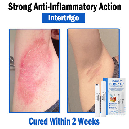 𝐇𝐄𝐀𝐓𝐖𝐎𝐋𝐅®👩‍⚕️ 𝐃𝒆𝐫𝐦𝒁𝐚𝐩 𝑵𝐁-𝐔𝐕𝐁 𝑴𝐨𝐥𝐞 & 𝑾𝐚𝐫𝐭 𝑹𝒆𝐦𝐨𝐯𝐚𝐥 𝑷𝐡𝐨𝐭𝐨𝐭𝐡𝐞𝐫𝐚𝐩𝐲 𝑳𝐚𝐬𝒆𝐫 𝑷𝐞𝐧 (Effectively inhibits excessive cell proliferation, eliminates inflammation and repairs the skin barrier)