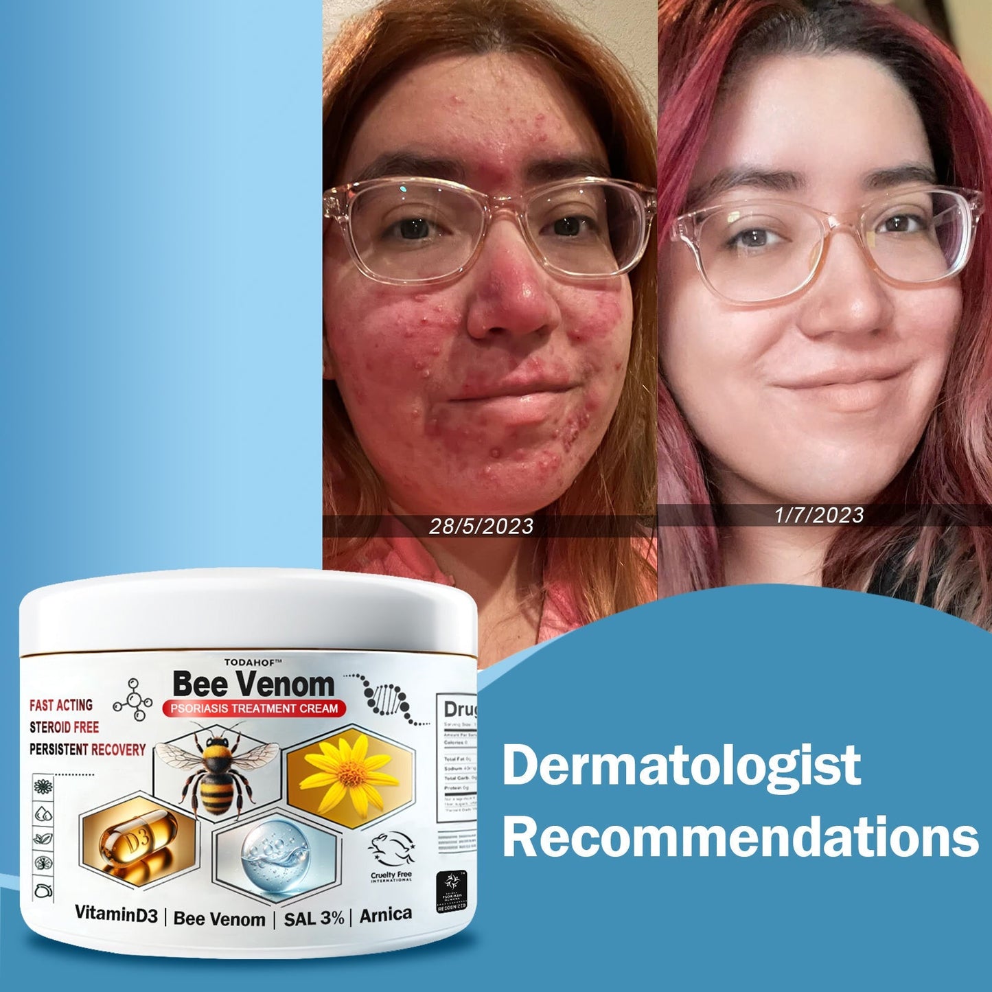 TODAHOF™🥑 Bee Venom Psoriasis Multi-Symptom Treatment Cream (👨‍⚕NPF RECOMMENDS)