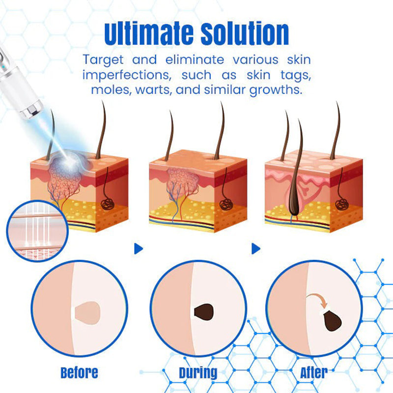 𝐇𝐄𝐀𝐓𝐖𝐎𝐋𝐅®👩‍⚕️ 𝐃𝒆𝐫𝐦𝒁𝐚𝐩 𝑵𝐁-𝐔𝐕𝐁 𝑴𝐨𝐥𝐞 & 𝑾𝐚𝐫𝐭 𝑹𝒆𝐦𝐨𝐯𝐚𝐥 𝑷𝐡𝐨𝐭𝐨𝐭𝐡𝐞𝐫𝐚𝐩𝐲 𝑳𝐚𝐬𝒆𝐫 𝑷𝐞𝐧 (Effectively inhibits excessive cell proliferation, eliminates inflammation and repairs the skin barrier)