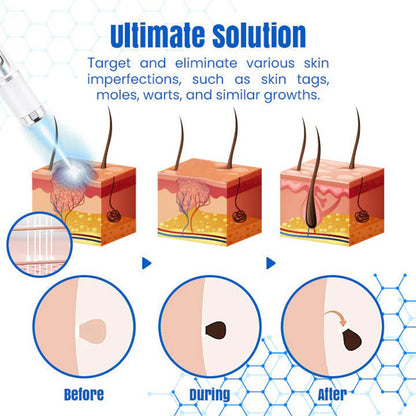 𝐇𝐄𝐀𝐓𝐖𝐎𝐋𝐅®👩‍⚕️ 𝐃𝒆𝐫𝐦𝒁𝐚𝐩 𝑵𝐁-𝐔𝐕𝐁 𝑴𝐨𝐥𝐞 & 𝑾𝐚𝐫𝐭 𝑹𝒆𝐦𝐨𝐯𝐚𝐥 𝑷𝐡𝐨𝐭𝐨𝐭𝐡𝐞𝐫𝐚𝐩𝐲 𝑳𝐚𝐬𝒆𝐫 𝑷𝐞𝐧 (Effectively inhibits excessive cell proliferation, eliminates inflammation and repairs the skin barrier)