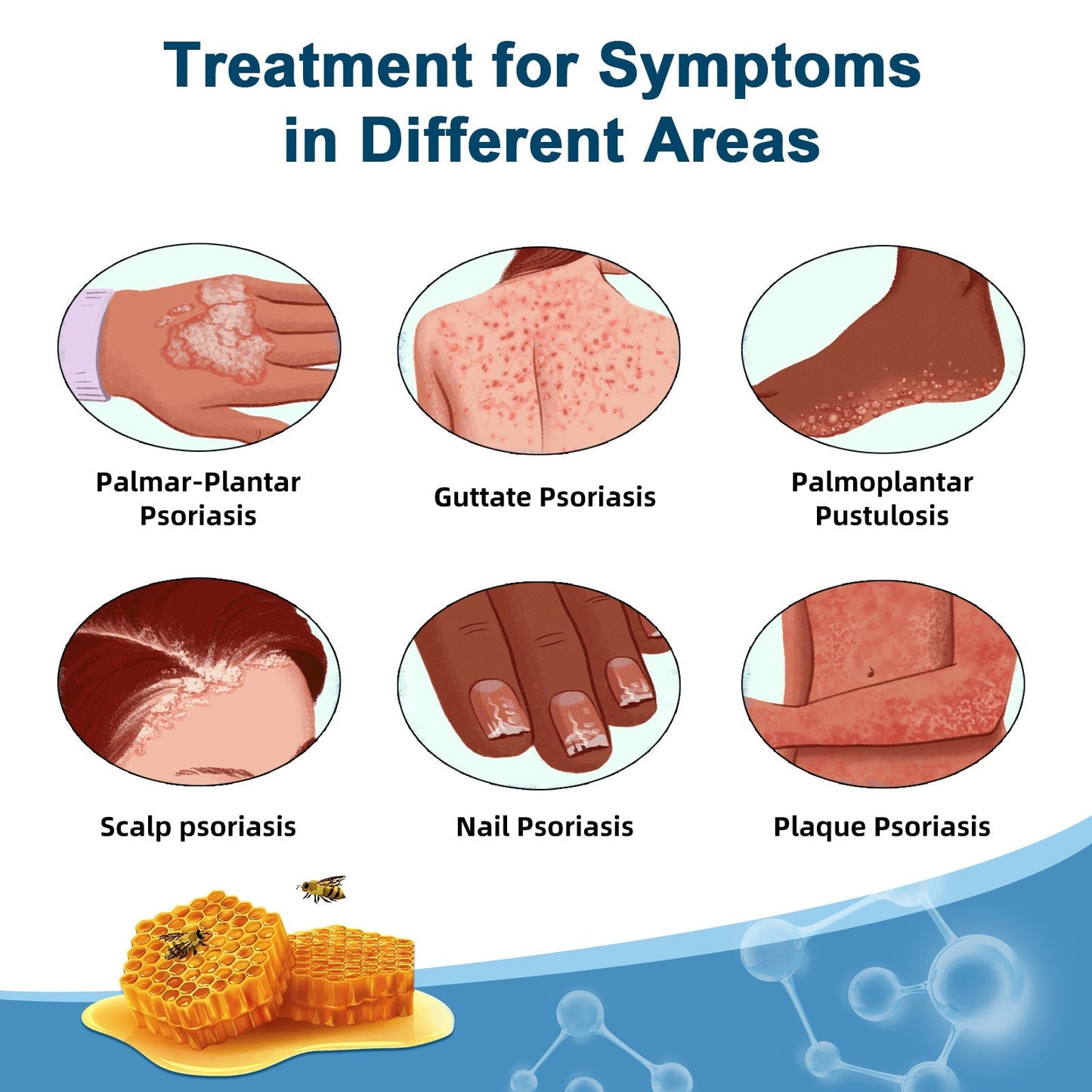 TODAHOF™🥑 Bee Venom Psoriasis Multi-Symptom Treatment Cream (👨‍⚕NPF RECOMMENDS)