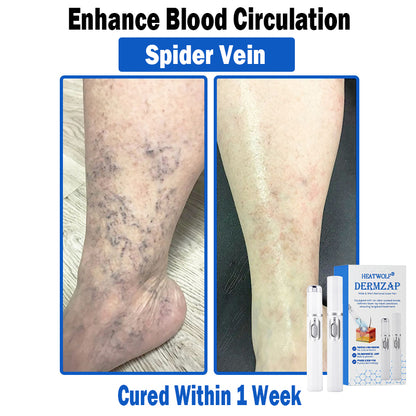 𝐇𝐄𝐀𝐓𝐖𝐎𝐋𝐅®👩‍⚕️ 𝐃𝒆𝐫𝐦𝒁𝐚𝐩 𝑵𝐁-𝐔𝐕𝐁 𝑴𝐨𝐥𝐞 & 𝑾𝐚𝐫𝐭 𝑹𝒆𝐦𝐨𝐯𝐚𝐥 𝑷𝐡𝐨𝐭𝐨𝐭𝐡𝐞𝐫𝐚𝐩𝐲 𝑳𝐚𝐬𝒆𝐫 𝑷𝐞𝐧 (Effectively inhibits excessive cell proliferation, eliminates inflammation and repairs the skin barrier)