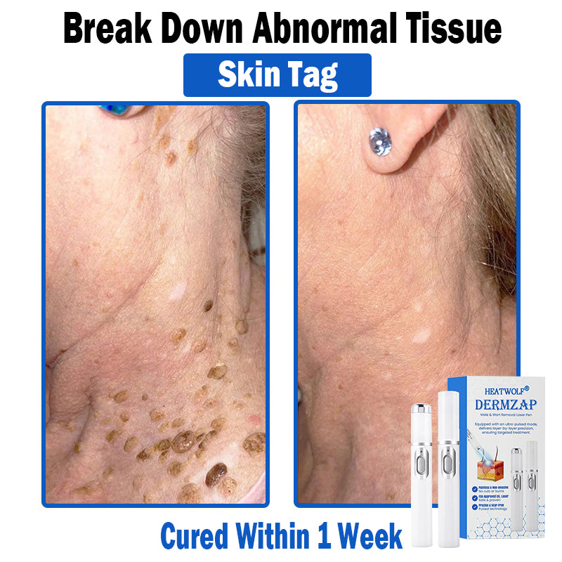 𝐇𝐄𝐀𝐓𝐖𝐎𝐋𝐅®👩‍⚕️ 𝐃𝒆𝐫𝐦𝒁𝐚𝐩 𝑵𝐁-𝐔𝐕𝐁 𝑴𝐨𝐥𝐞 & 𝑾𝐚𝐫𝐭 𝑹𝒆𝐦𝐨𝐯𝐚𝐥 𝑷𝐡𝐨𝐭𝐨𝐭𝐡𝐞𝐫𝐚𝐩𝐲 𝑳𝐚𝐬𝒆𝐫 𝑷𝐞𝐧 (Effectively inhibits excessive cell proliferation, eliminates inflammation and repairs the skin barrier)