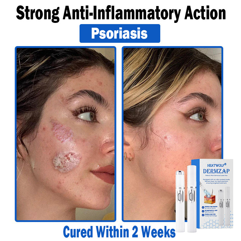 𝐇𝐄𝐀𝐓𝐖𝐎𝐋𝐅®👩‍⚕️ 𝐃𝒆𝐫𝐦𝒁𝐚𝐩 𝑵𝐁-𝐔𝐕𝐁 𝑴𝐨𝐥𝐞 & 𝑾𝐚𝐫𝐭 𝑹𝒆𝐦𝐨𝐯𝐚𝐥 𝑷𝐡𝐨𝐭𝐨𝐭𝐡𝐞𝐫𝐚𝐩𝐲 𝑳𝐚𝐬𝒆𝐫 𝑷𝐞𝐧 (Effectively inhibits excessive cell proliferation, eliminates inflammation and repairs the skin barrier)