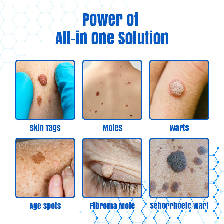 𝐇𝐄𝐀𝐓𝐖𝐎𝐋𝐅®👩‍⚕️ 𝐃𝒆𝐫𝐦𝒁𝐚𝐩 𝑵𝐁-𝐔𝐕𝐁 𝑴𝐨𝐥𝐞 & 𝑾𝐚𝐫𝐭 𝑹𝒆𝐦𝐨𝐯𝐚𝐥 𝑷𝐡𝐨𝐭𝐨𝐭𝐡𝐞𝐫𝐚𝐩𝐲 𝑳𝐚𝐬𝒆𝐫 𝑷𝐞𝐧 (Effectively inhibits excessive cell proliferation, eliminates inflammation and repairs the skin barrier)